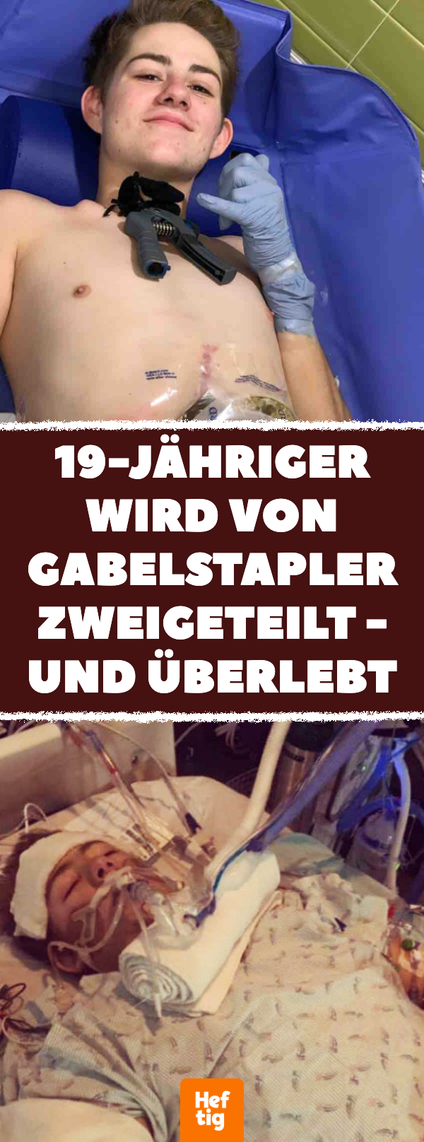 19-Jähriger wird von Gabelstapler zweigeteilt – und überlebt